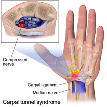 Carpal Tunnel Syndrome