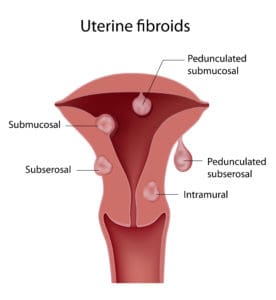 Uterine fibroid