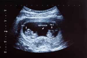 Ultrasound scan of twins