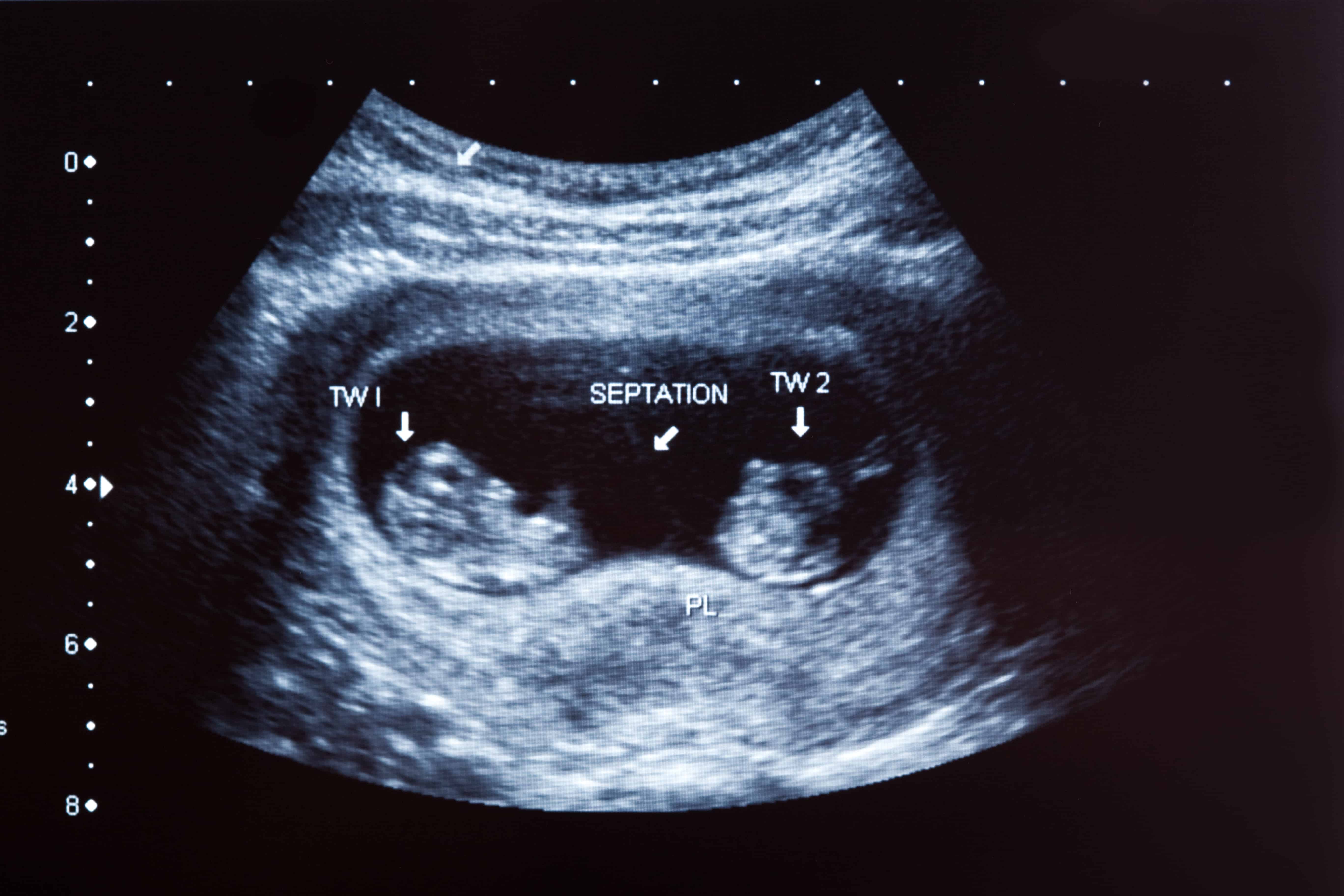 screening ultrasounds
