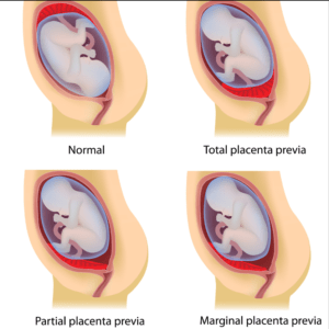 PLACENTA PREVIA