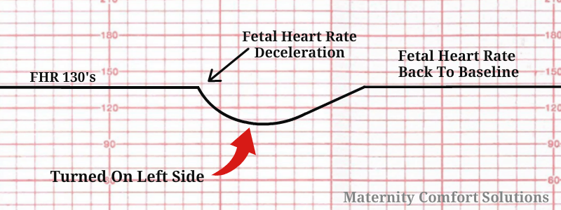 left-sided sleep during pregnancy fetal heart rate tracing