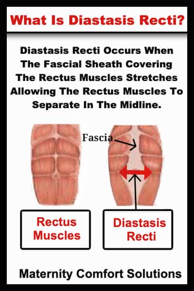 What is diastasis recti