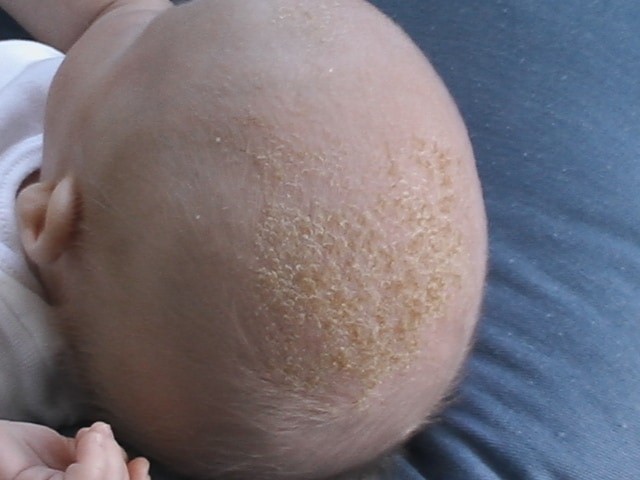 11 Common Baby Rashes A Mom S Quick Guide