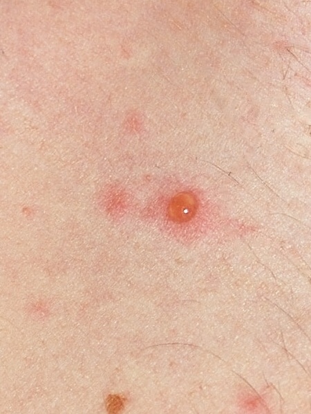 Chickenpox blister