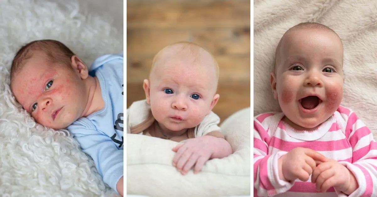 common baby rashes in newborns