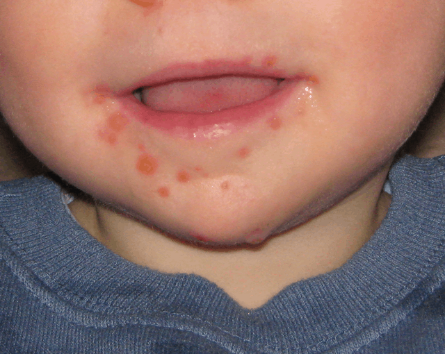 Hand_Foot_Mouth_Disease