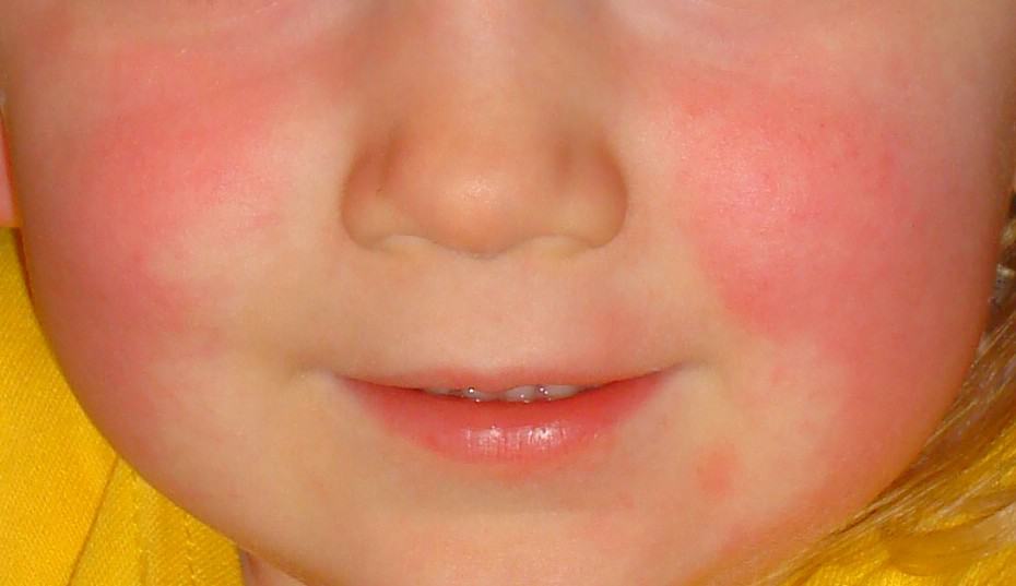 1 Common Baby Rashes A Mom s Quick Guide