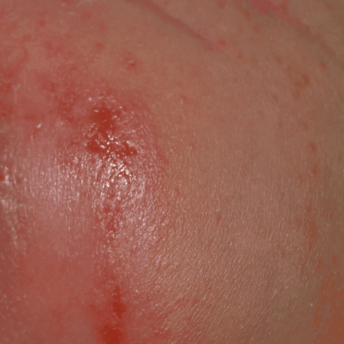 Diaper rash in infants