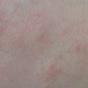 eczema