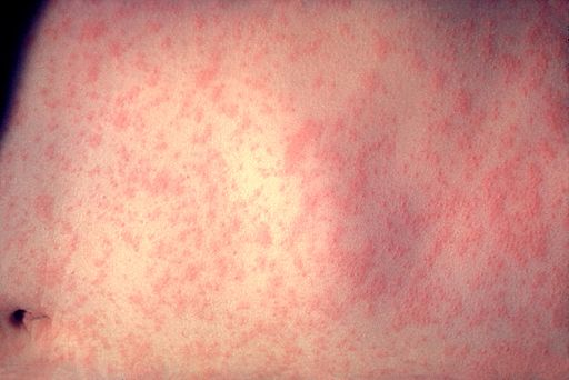 measles rash