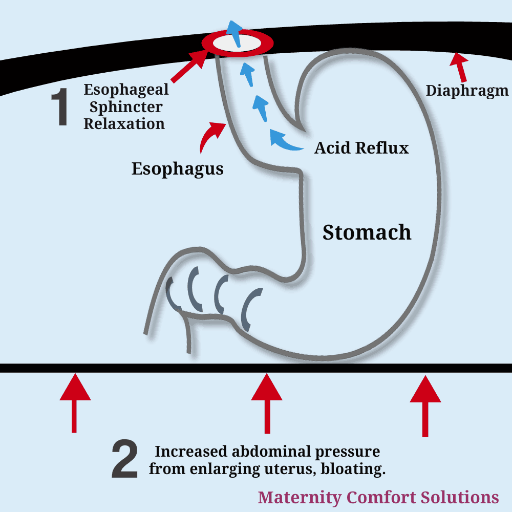 how-to-relieve-heartburn-during-pregnancy-without-medication