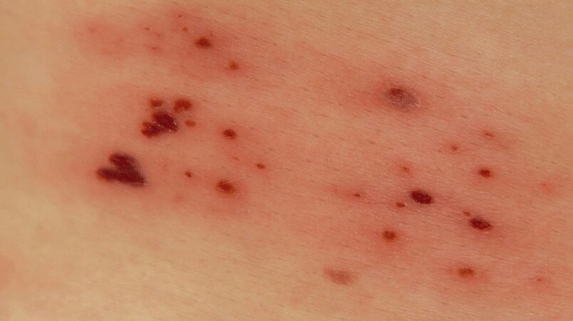 Bacterial dermatitis