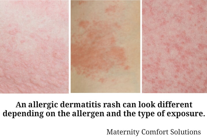 allergic dermatitis