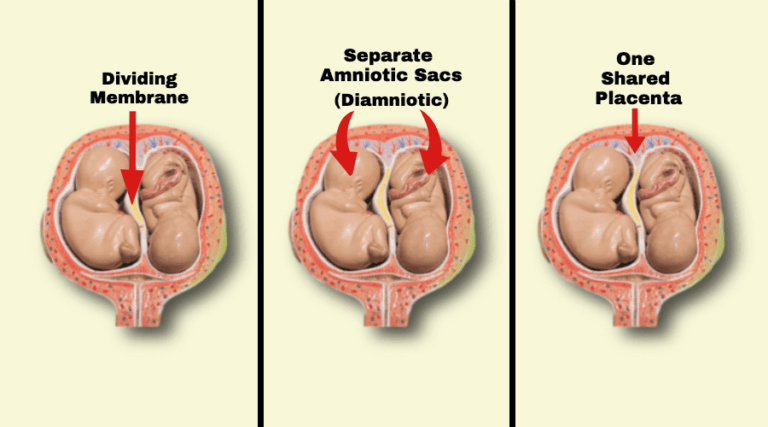 what-questions-to-ask-your-doctor-if-you-are-having-twins