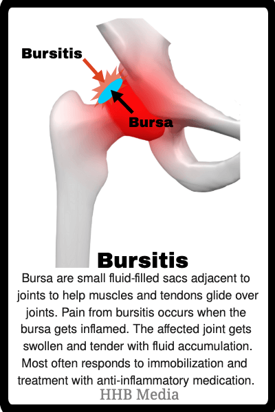 <span style='background-color:none;'>hip pain</span><span style='background-color:none;'> </span>- bursitis