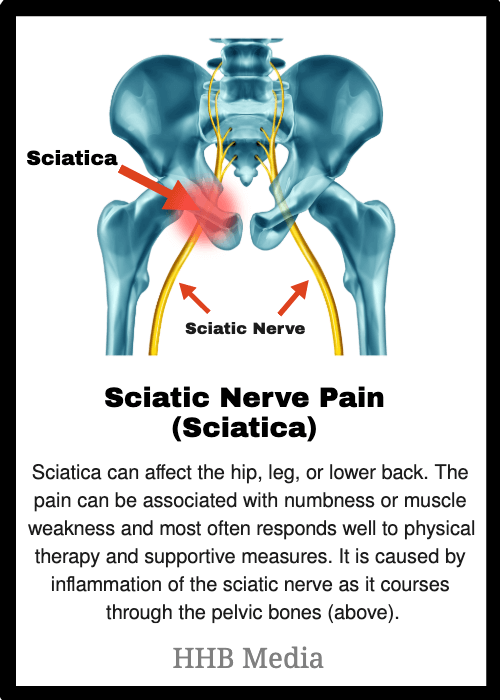 <span style='background-color:none;'>hip pain</span><span style='background-color:none;'> </span>- sciatica